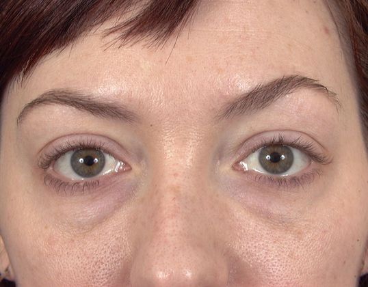 Facial Rejuvenation Case 7 - Before