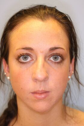 Rhinoplasty: Case 6 - Before