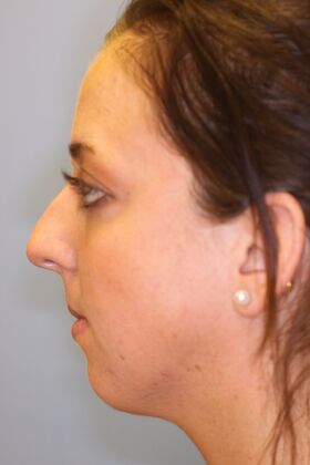 Rhinoplasty: Case 6 - Before