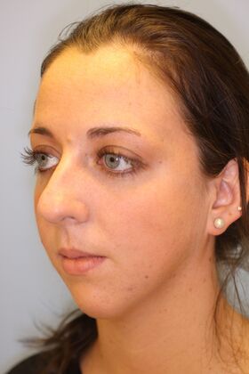 Rhinoplasty: Case 6 - Before