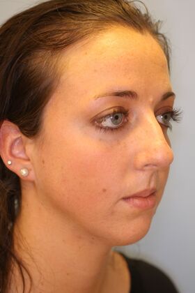 Rhinoplasty: Case 6 - Before