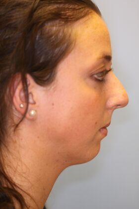 Rhinoplasty: Case 6 - Before