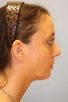 Rhinoplasty: Case 6 - After