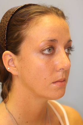 Rhinoplasty: Case 6 - After