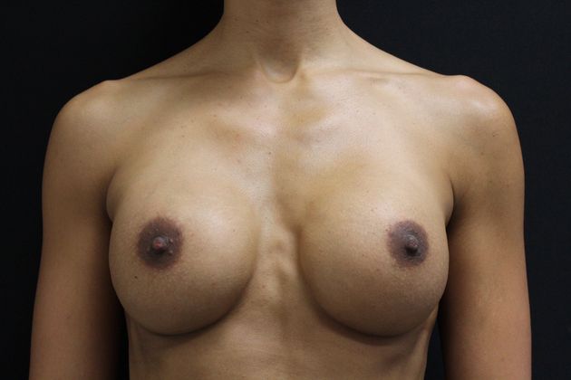 Breast Augmentation Exchange/Revision: Case 9 - Before
