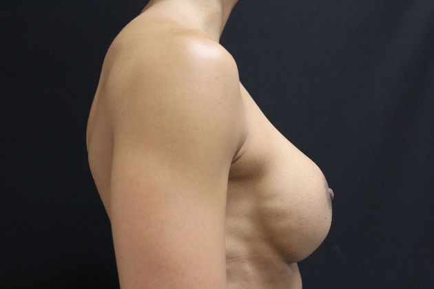 Breast Augmentation Exchange/Revision: Case 9 - Before