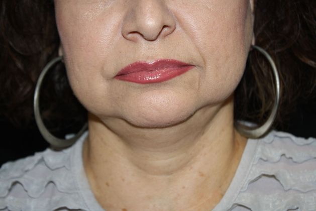 Liposuction Case 2 - Before