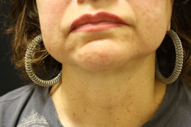 Liposuction Case 2 - After