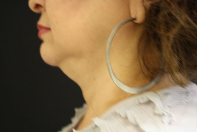 Liposuction: Case 2 - Before