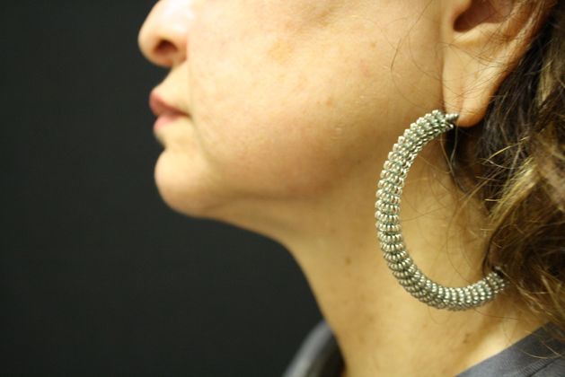 Liposuction: Case 2 - After