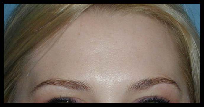 Facial Rejuvenation Case 8 - After
