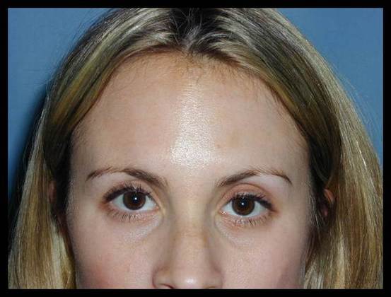 Facial Rejuvenation: Case 8 - After