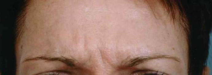 Facial Rejuvenation Case 9 - Before