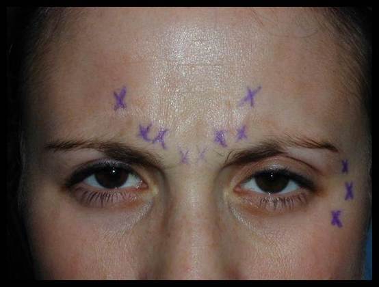 Facial Rejuvenation: Case 9 - Before