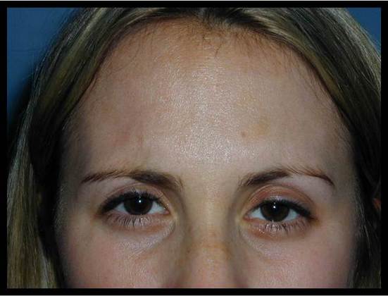 Facial Rejuvenation: Case 9 - After