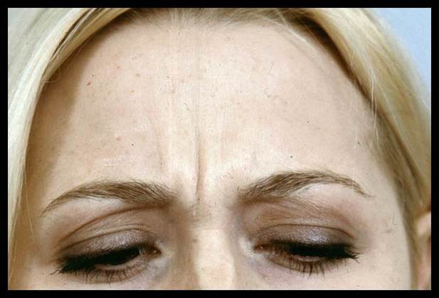 Facial Rejuvenation: Case 9 - Before