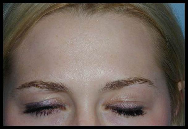 Facial Rejuvenation: Case 9 - After