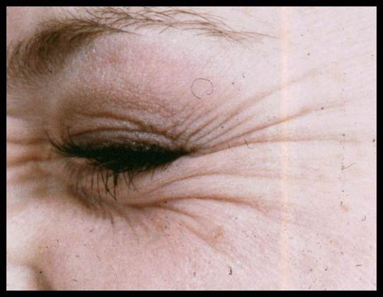 Facial Rejuvenation Case 10 - Before