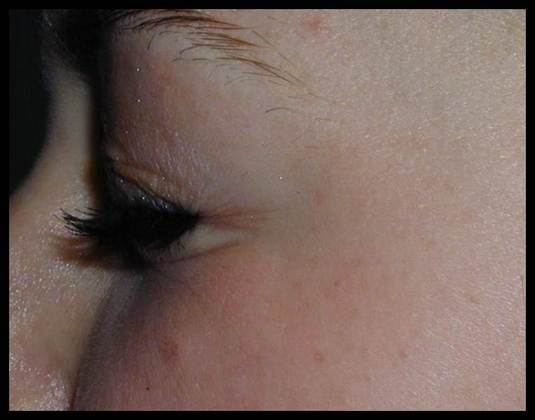 Facial Rejuvenation Case 10 - After