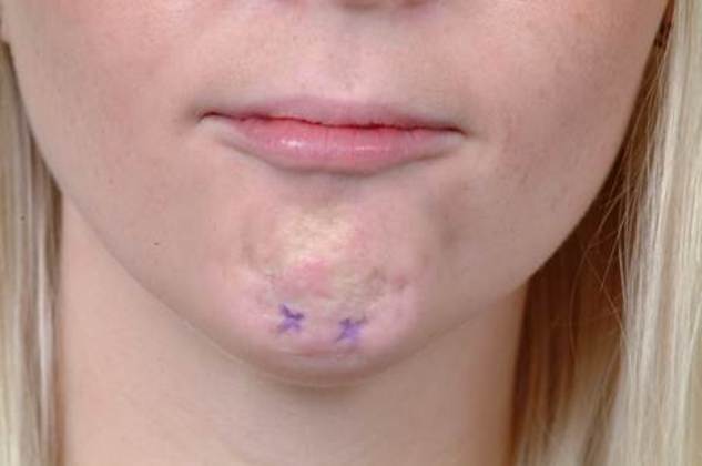 Facial Rejuvenation: Case 10 - Before