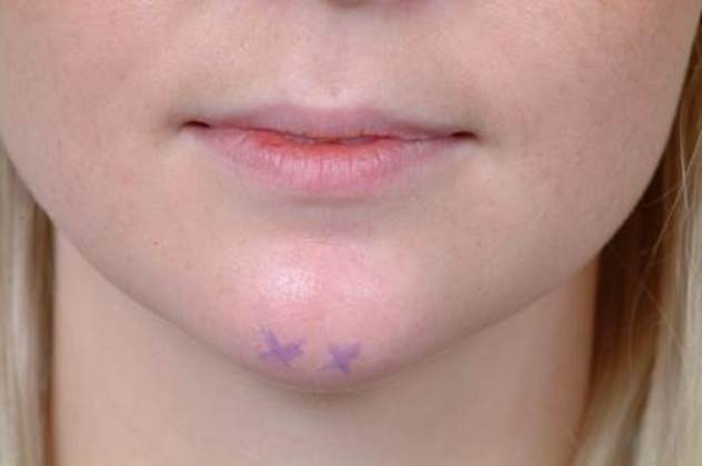 Facial Rejuvenation: Case 10 - After