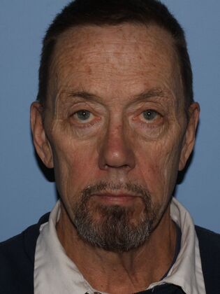 Facial Rejuvenation Case 11 - Before