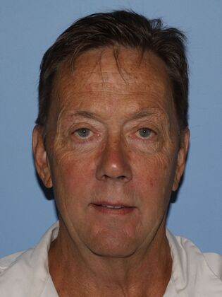 Facial Rejuvenation Case 11 - After