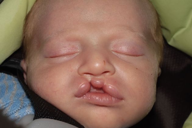 Cleft Lip and Palate: Case 2 - Boy with bilateral cleft lip