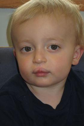 Cleft Lip and Palate: Case 2 - After repair