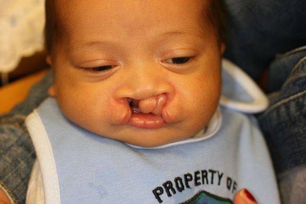 Cleft Lip and Palate: Case 3 - Child with bilateral cleft lip