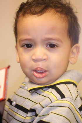 Cleft Lip and Palate: Case 3 - After repair