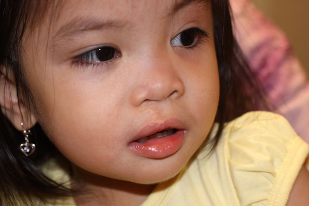 Cleft Lip and Palate: Case 4 - After repair
