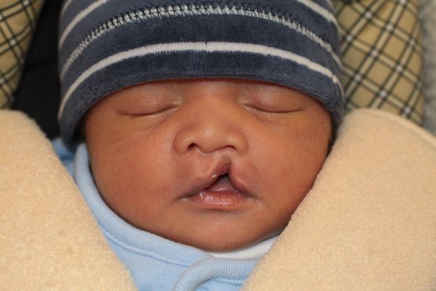 Cleft Lip and Palate: Case 5 - Child with a cleft lip