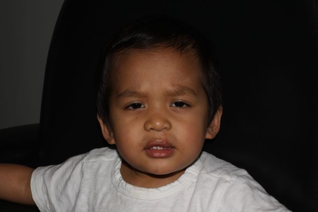 Cleft Lip and Palate: Case 5 - After repair
