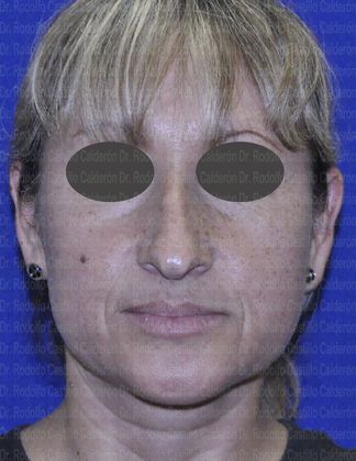 Rhinoplasty: Open Rhinoplasty in a Difficult Nose - Before open Rhinoplasty frontal view