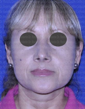 Rhinoplasty: Open Rhinoplasty in a Difficult Nose - After open Rhinoplasty frontal view