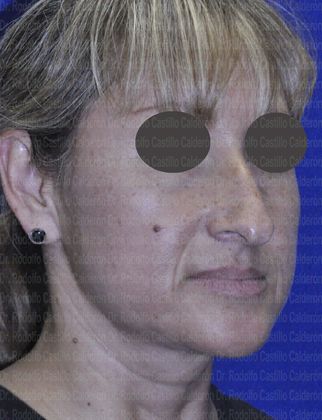 Rhinoplasty: Open Rhinoplasty in a Difficult Nose - Before open Rhinoplasty oblique view