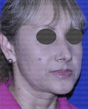 Rhinoplasty: Open Rhinoplasty in a Difficult Nose - After open Rhinoplasty oblique view