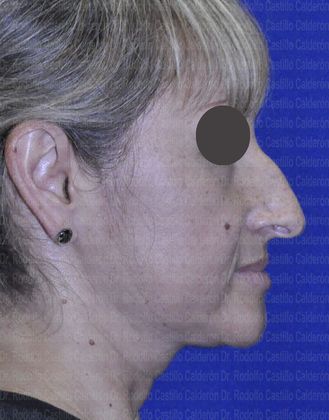 Rhinoplasty: Open Rhinoplasty in a Difficult Nose - before open Rhinoplasty lateral view