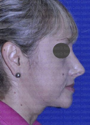 Rhinoplasty: Open Rhinoplasty in a Difficult Nose - after open Rhinoplasty lateral view