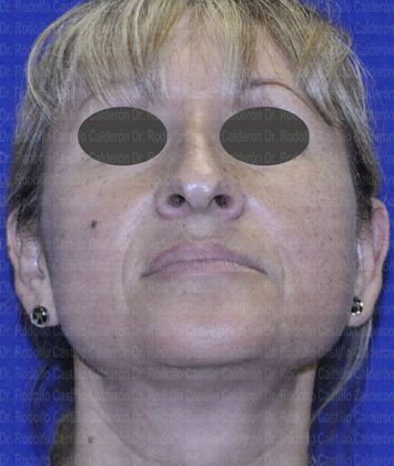 Rhinoplasty: Open Rhinoplasty in a Difficult Nose - before open Rhinoplasty inferior view