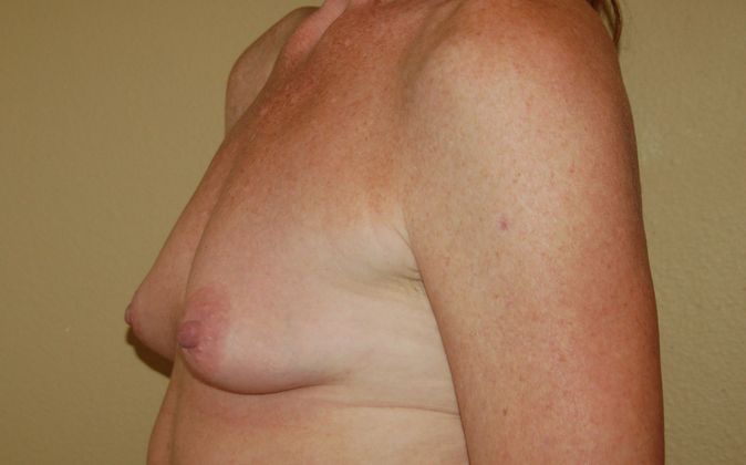 Breast Augmentation: Case 220 - Before