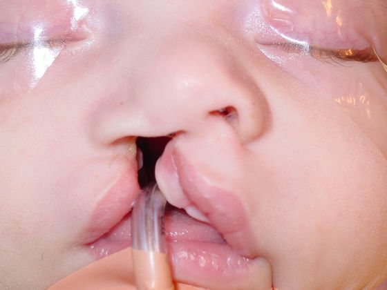 Cleft Lip and Palate: Case 6 - Child with a cleft lip
