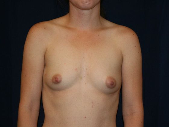 Breast Augmentation*: Case 52 - Before