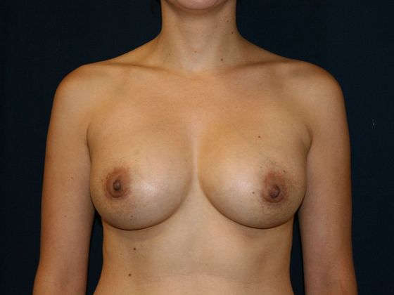 Breast Augmentation*: Case 32 - After