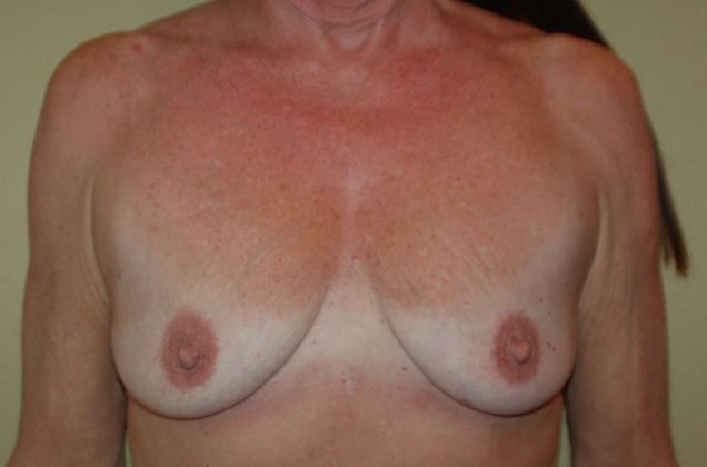 Breast Augmentation w/ Lift Case 94 - Before