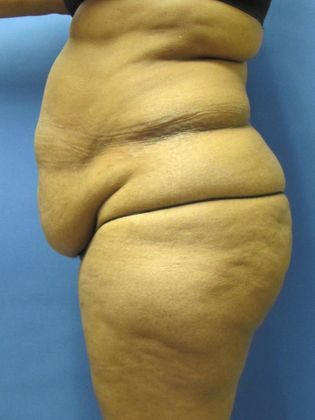 Abdominoplasty - Tummy Tuck: Case 5 - Before
