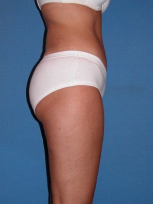 Abdominoplasty - Tummy Tuck: Case 1 - After