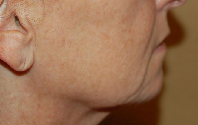 Facelift: Case 8 - Before