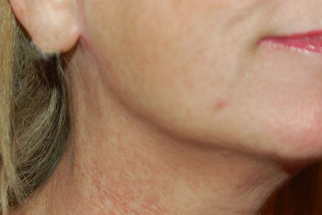 Facelift: Case 8 - After